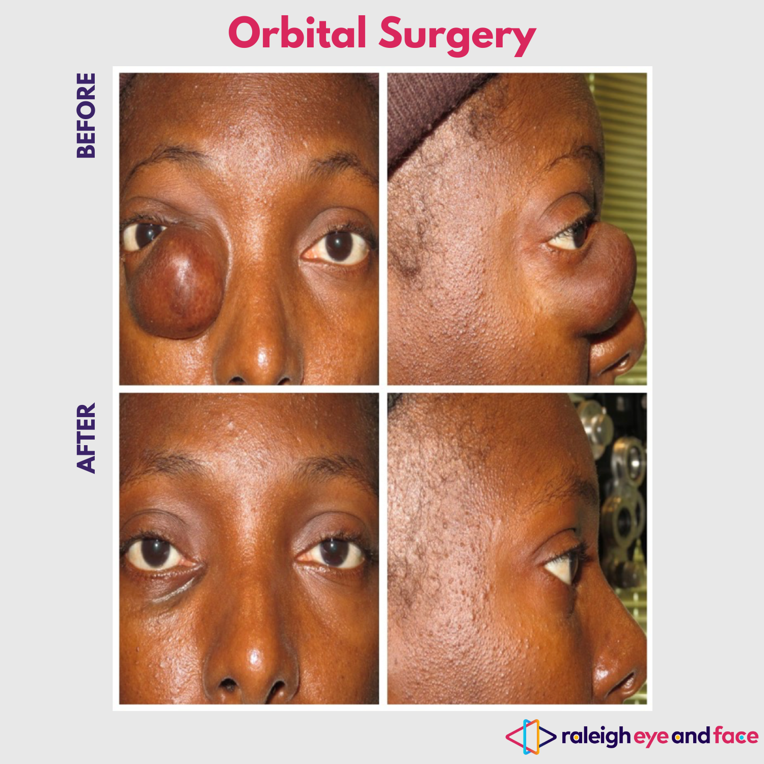 Eye tumor sale
